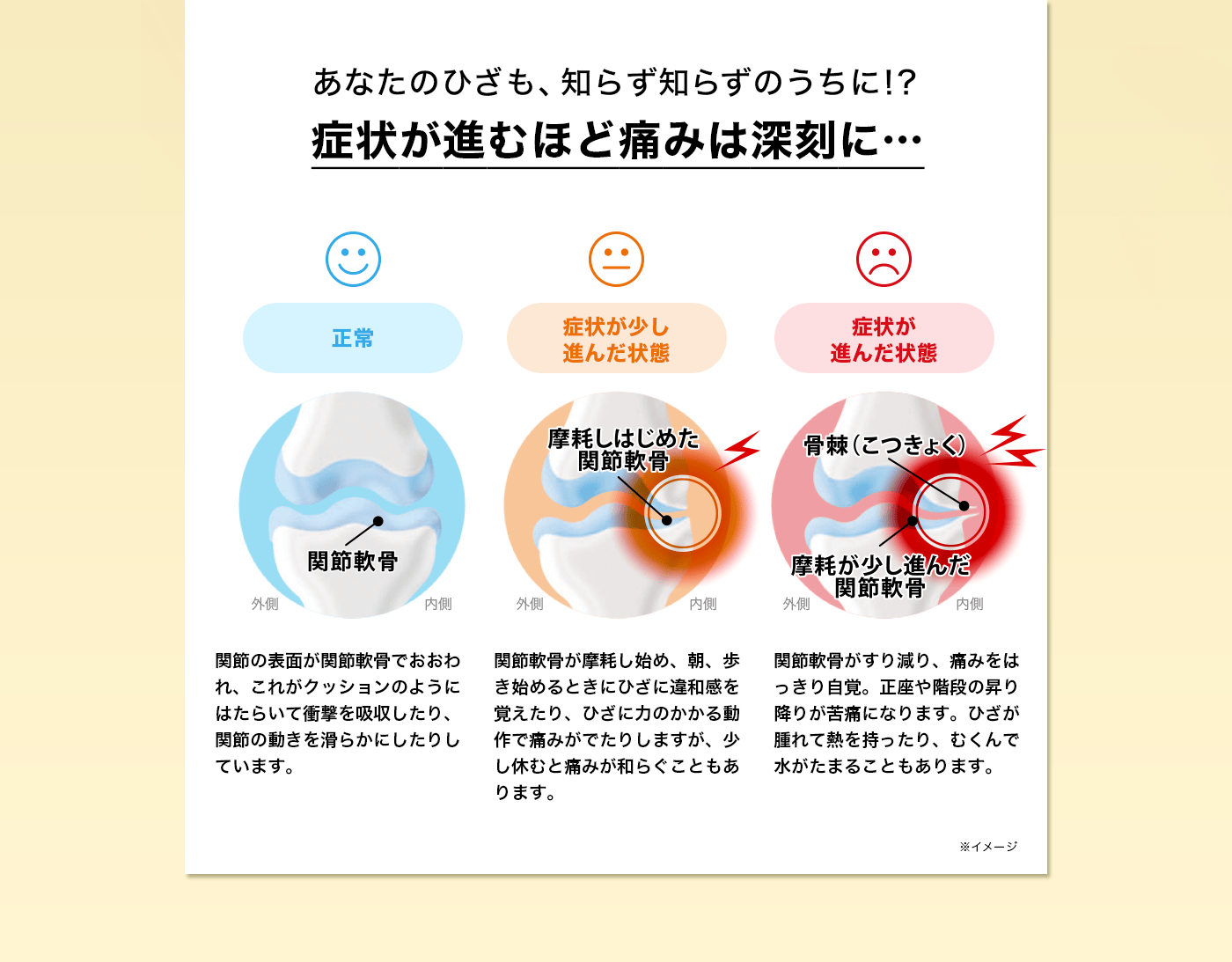 あなたのひざも、知らず知らずのうちに！？症状が進むほど痛みは深刻に・・・正常：関節の表面が関節軟骨でおおわれ、これがクッションのようにはたらいて衝撃を吸収したり、関節の動きを滑らかにしたりしています。　症状が少し進んだ状態：関節軟骨が摩耗し始め、朝、歩き始めるときにひざに違和感を覚えたり、ひざに力のかかる動作で痛みがでたりしますが、少し休むと痛みが和らぐこともあります。　症状が進んだ状態：関節軟骨がすり減り、痛みをはっきり自覚。正座や階段の昇り降りが苦痛になります。ひざが腫れて熱を持ったり、むくんで水がたまることもあります。