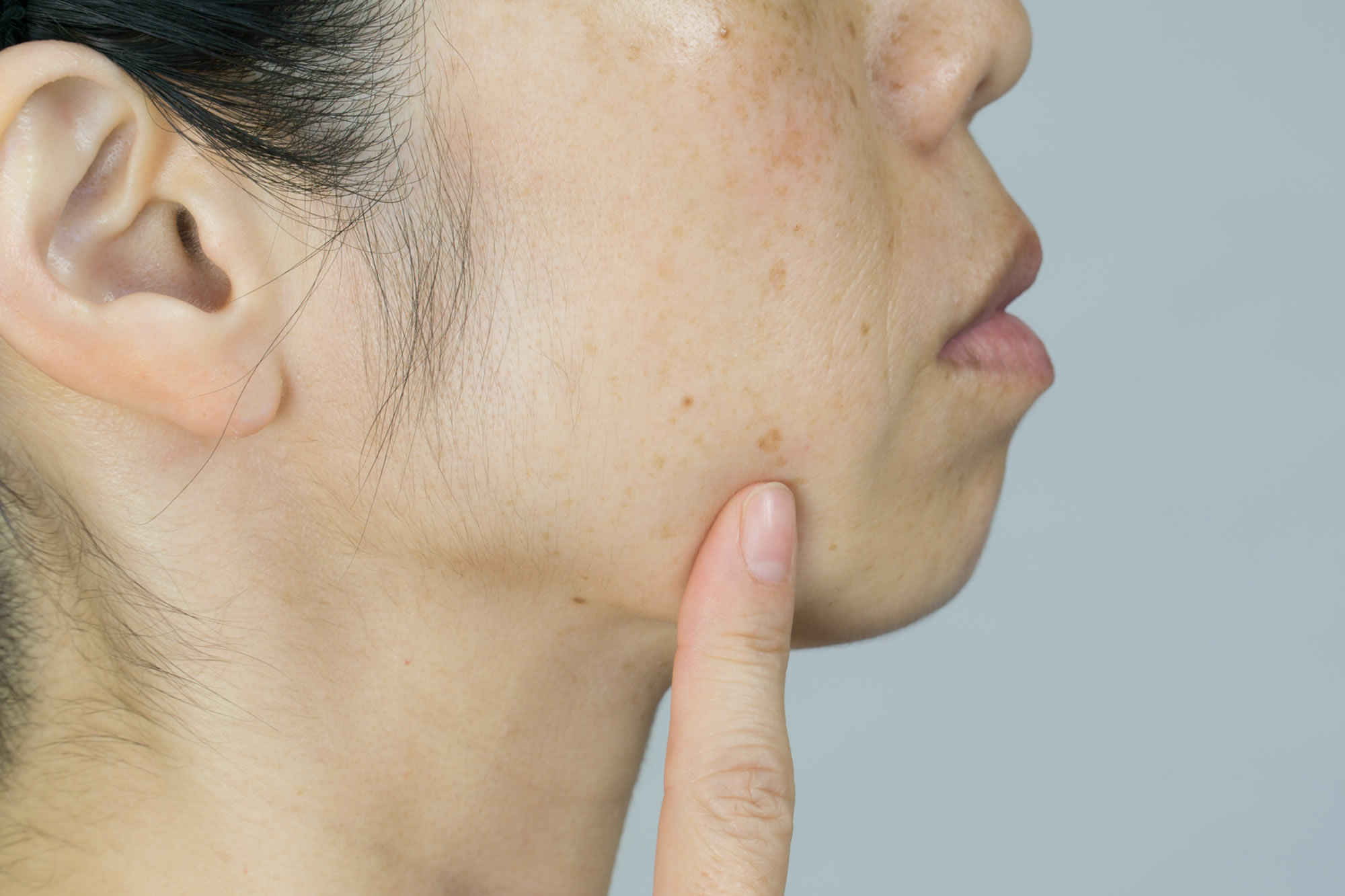 肌のシミ